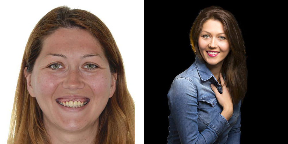 Extra-oral photo Before & After