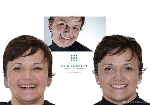 vertical face dimension