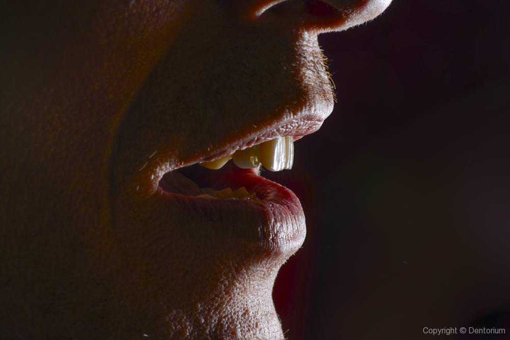 our patient Drazen - road to the perfect smile