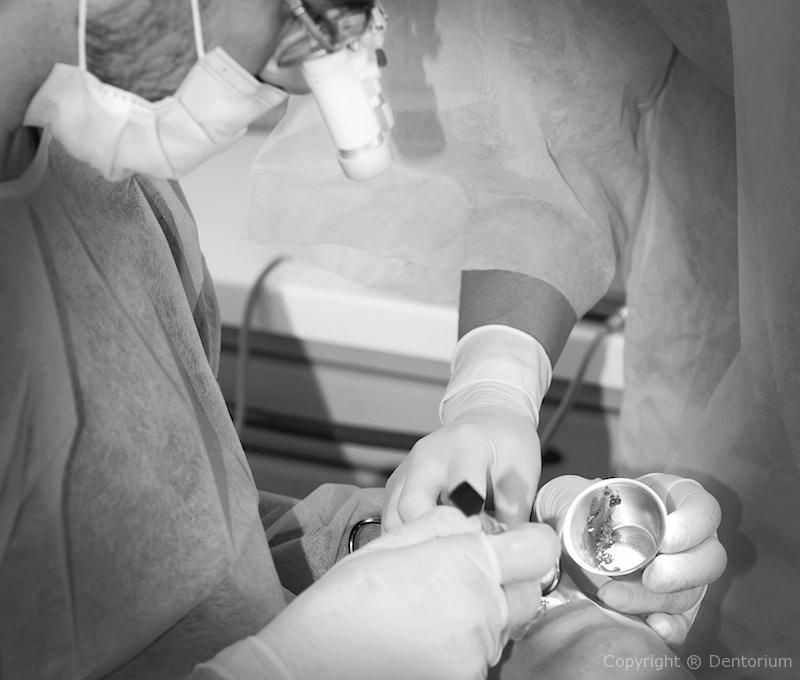 dental implants - procedure