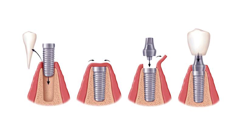 dental implants - procedure