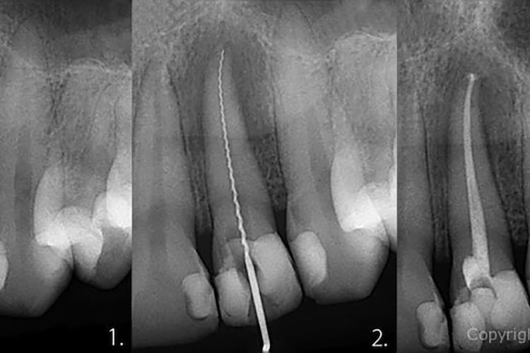 endo treatment