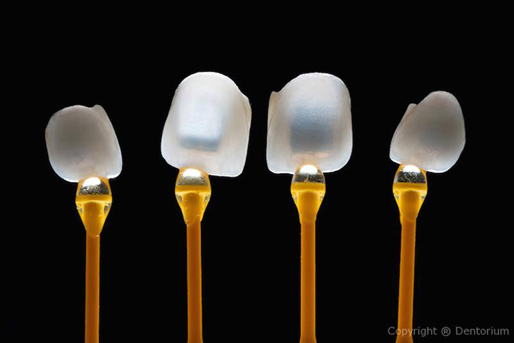 ceramic veneers