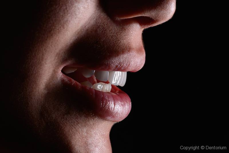 ceramic veneers - our patient Suzana