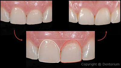 “Perio” treatment: Gingivoplasty